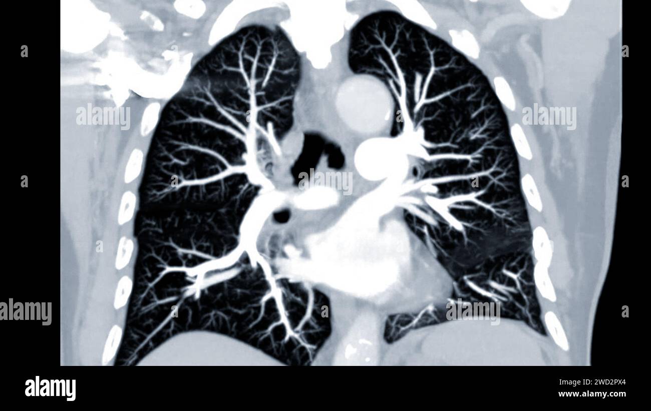 Artère pulmonaire CTPA ou CTA. Cette technique d'imagerie offre une vue claire des artères pulmonaires, facilitant le diagnostic de l'embolie pulmonaire, des canaux Banque D'Images
