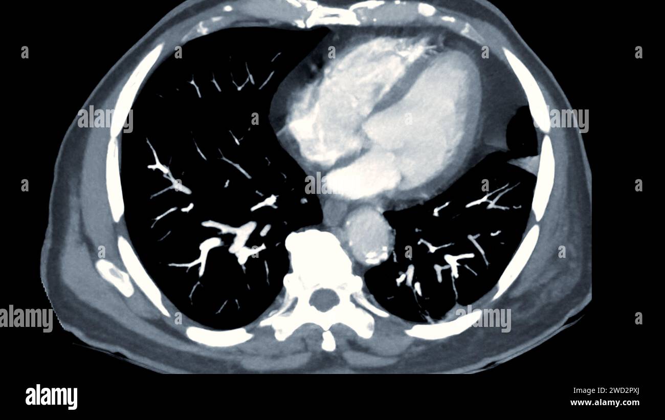 Artère pulmonaire CTPA ou CTA. Cette technique d'imagerie offre une vue claire des artères pulmonaires, facilitant le diagnostic de l'embolie pulmonaire, des canaux Banque D'Images