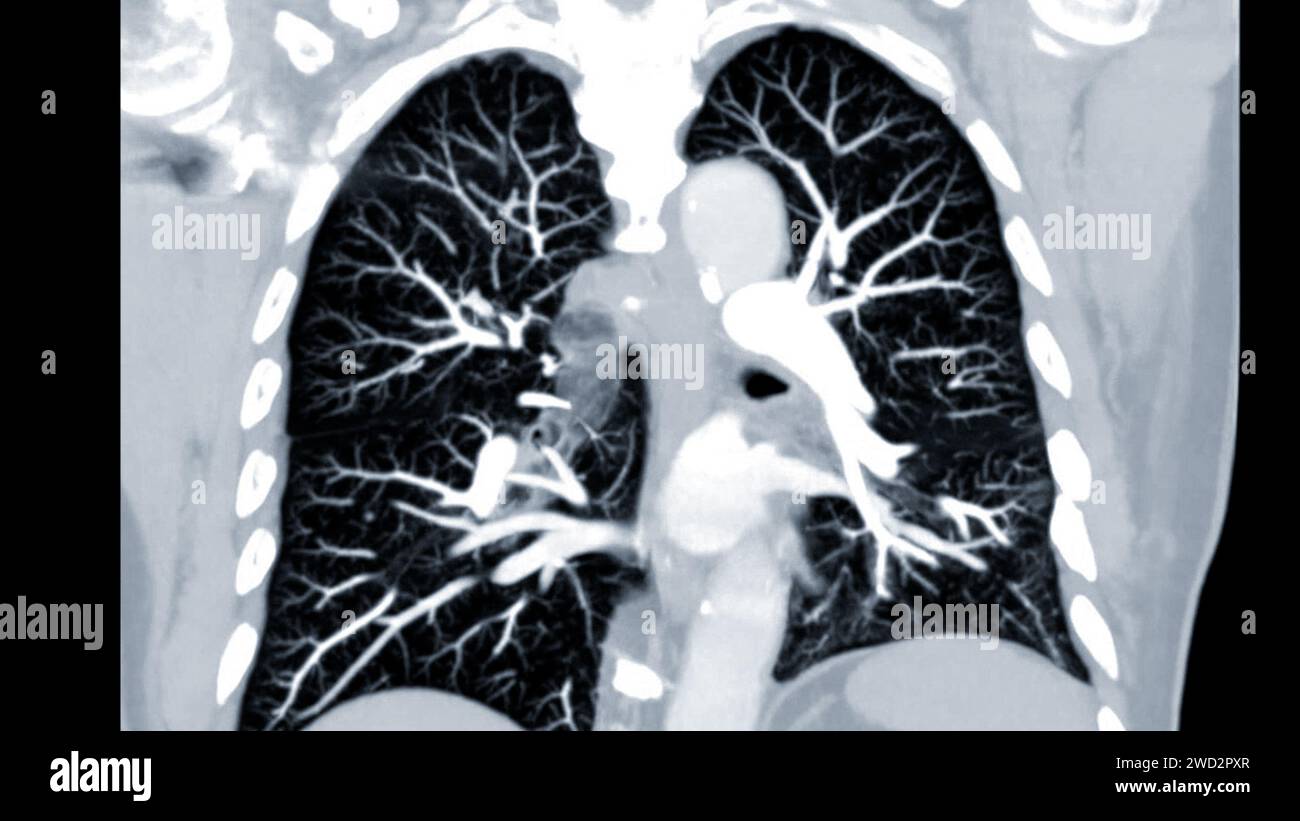 Artère pulmonaire CTPA ou CTA. Cette technique d'imagerie offre une vue claire des artères pulmonaires, facilitant le diagnostic de l'embolie pulmonaire, des canaux Banque D'Images