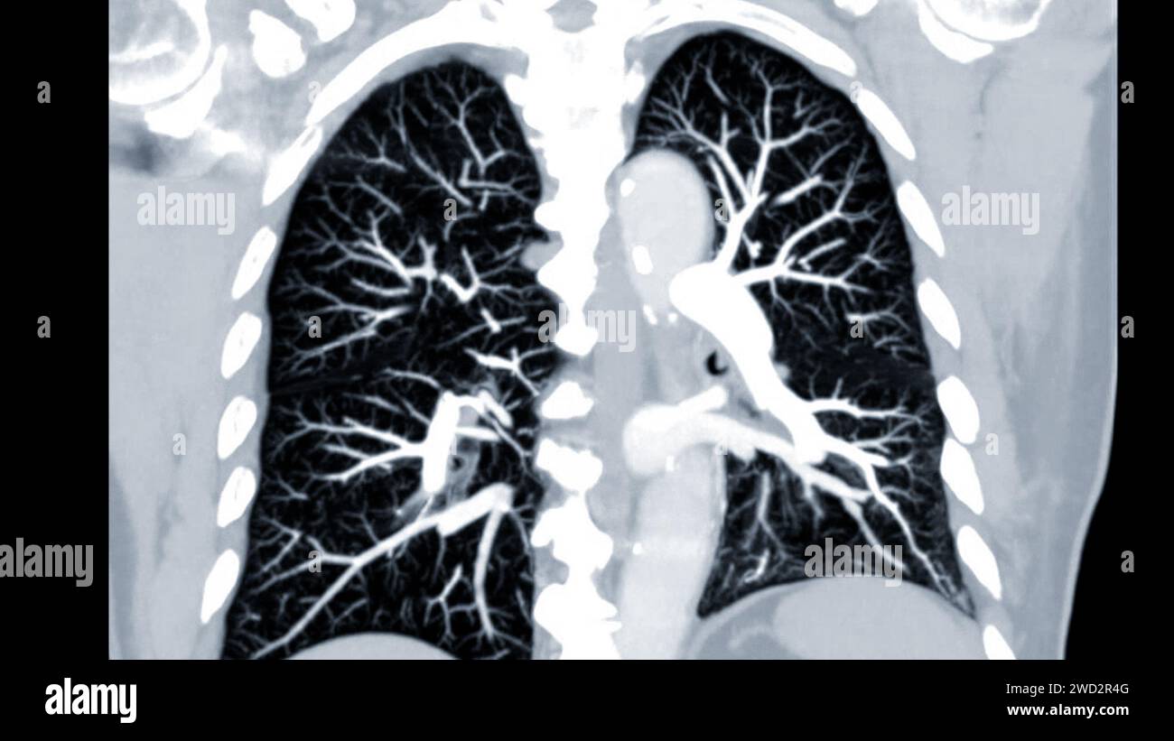 Artère pulmonaire CTPA ou CTA. Cette technique d'imagerie offre une vue claire des artères pulmonaires, facilitant le diagnostic de l'embolie pulmonaire, des canaux Banque D'Images