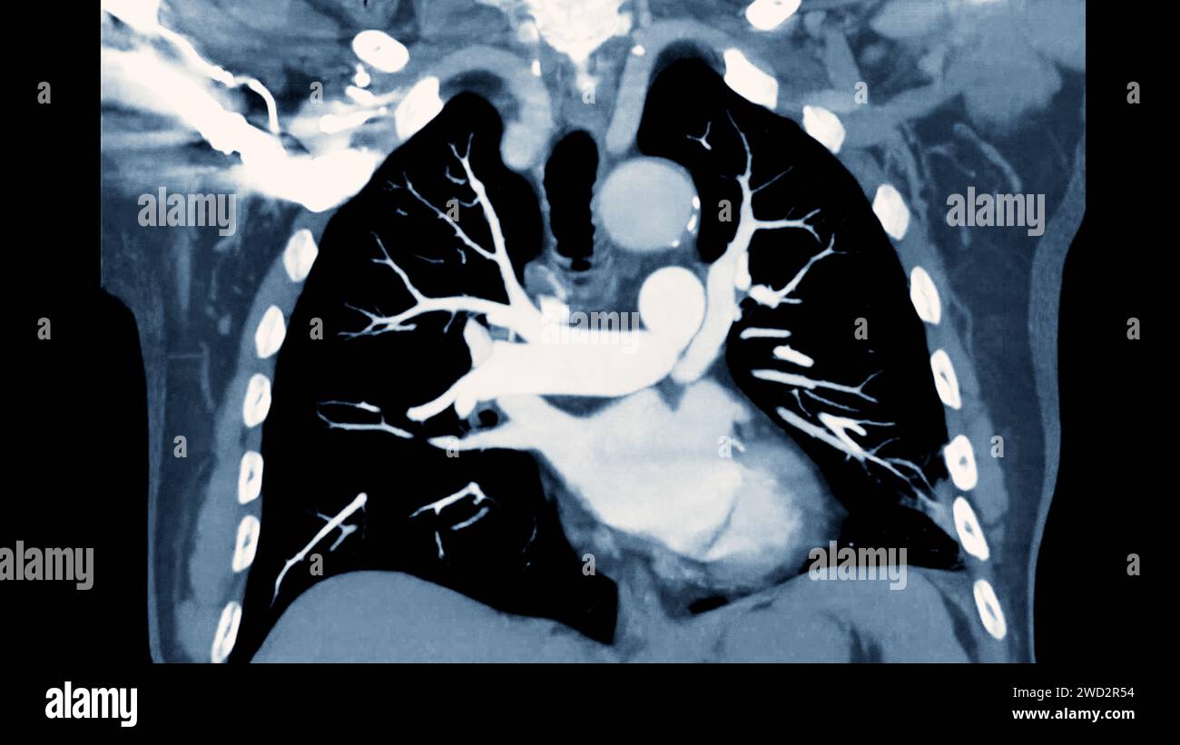Artère pulmonaire CTPA ou CTA. Cette technique d'imagerie offre une vue claire des artères pulmonaires, facilitant le diagnostic de l'embolie pulmonaire, des canaux Banque D'Images