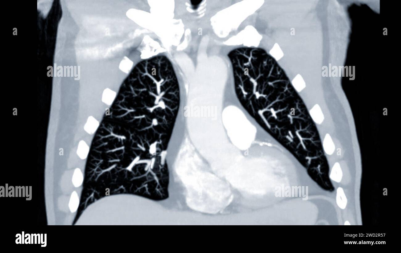Artère pulmonaire CTPA ou CTA. Cette technique d'imagerie offre une vue claire des artères pulmonaires, facilitant le diagnostic de l'embolie pulmonaire, des canaux Banque D'Images