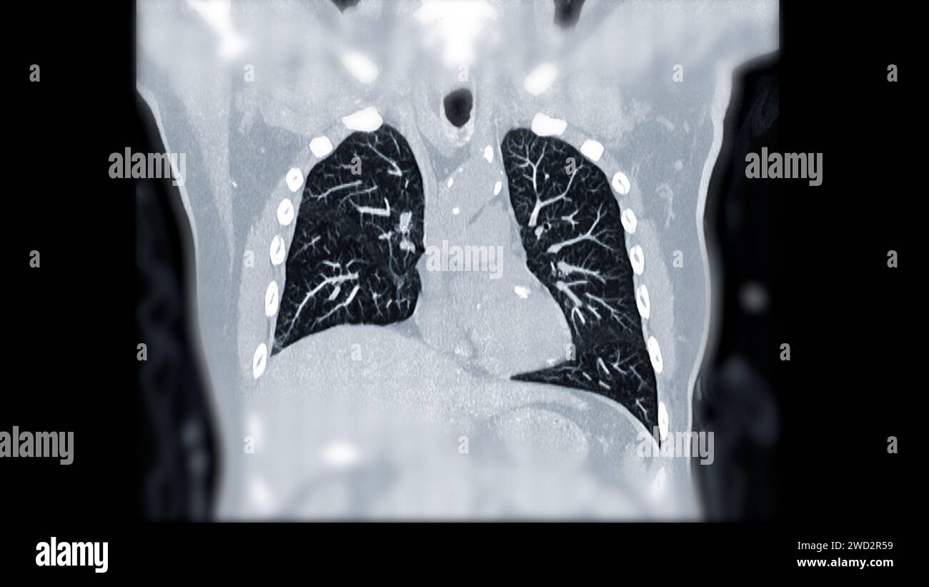 Artère pulmonaire CTPA ou CTA. Cette technique d'imagerie offre une vue claire des artères pulmonaires, facilitant le diagnostic de l'embolie pulmonaire, des canaux Banque D'Images