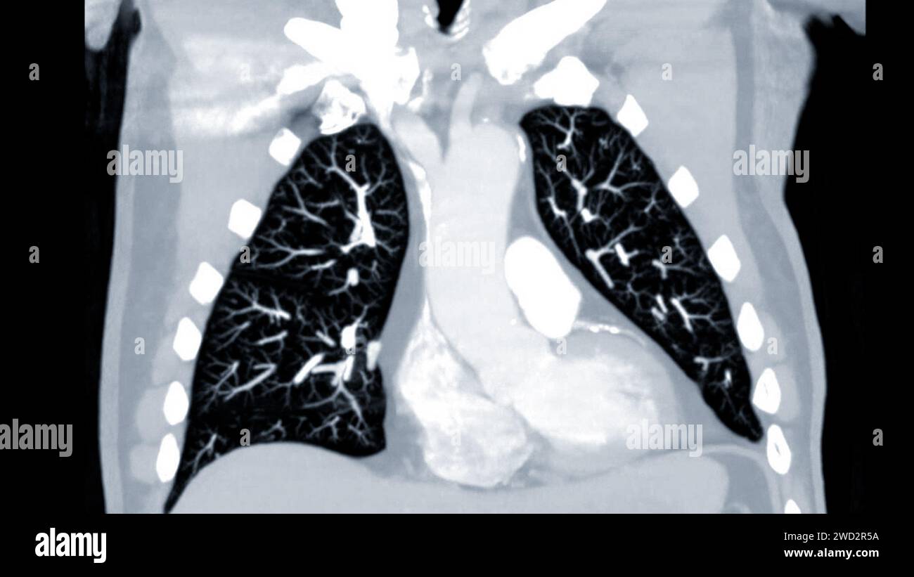 Artère pulmonaire CTPA ou CTA. Cette technique d'imagerie offre une vue claire des artères pulmonaires, facilitant le diagnostic de l'embolie pulmonaire, des canaux Banque D'Images