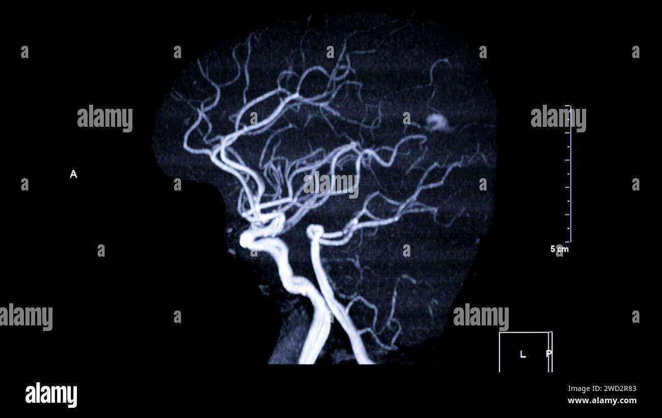 ARM cerveau , cette technique d'imagerie fournit des images claires des structures artérielles et veineuses du cerveau, aidant au diagnostic de l'état vasculaire Banque D'Images