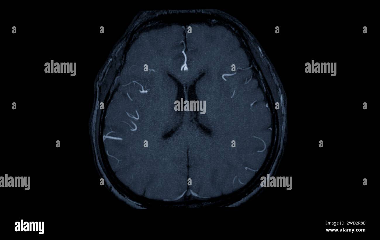 MRA Brain axial View , cette technique d'imagerie fournit des images claires des structures artérielles et veineuses du cerveau, facilitant ainsi le diagnostic du système vasculaire Banque D'Images