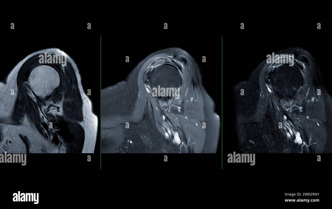 L'IRM de la vue sagittale de l'articulation de l'épaule est une technique d'imagerie non invasive fournissant des informations détaillées sur les structures de l'épaule. pour evalu Banque D'Images