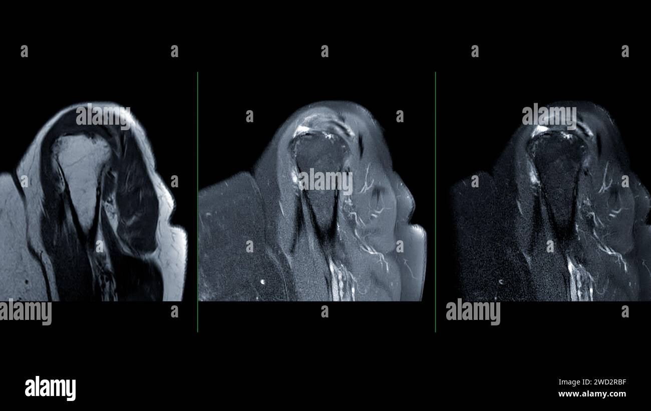 L'IRM de la vue sagittale de l'articulation de l'épaule est une technique d'imagerie non invasive fournissant des informations détaillées sur les structures de l'épaule. pour evalu Banque D'Images