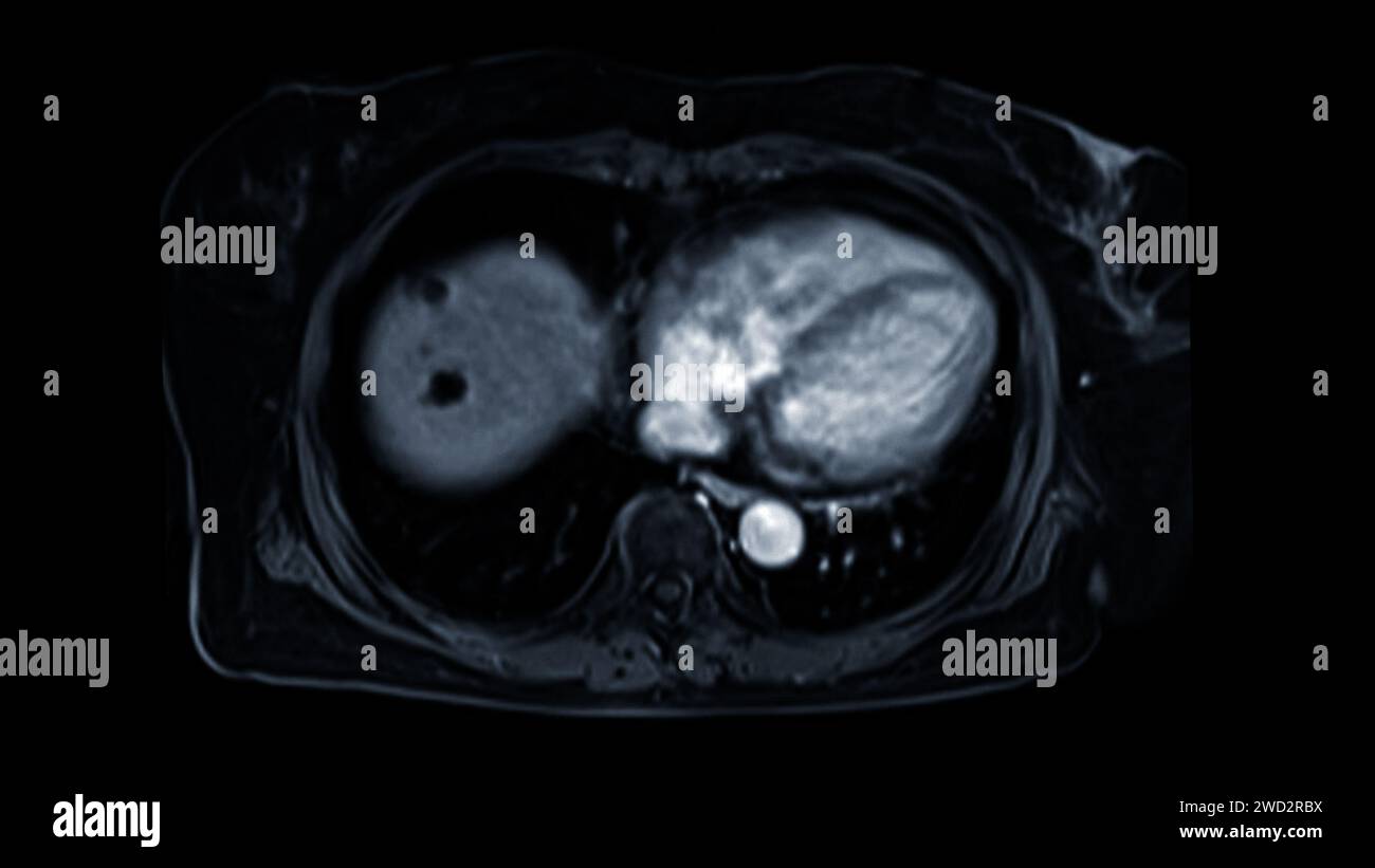 L'IRM de la vue axiale de la partie supérieure de l'abdomen est une technique d'imagerie non invasive qui fournit des images détaillées d'organes comme le foie, le pancréas et les reins. Banque D'Images