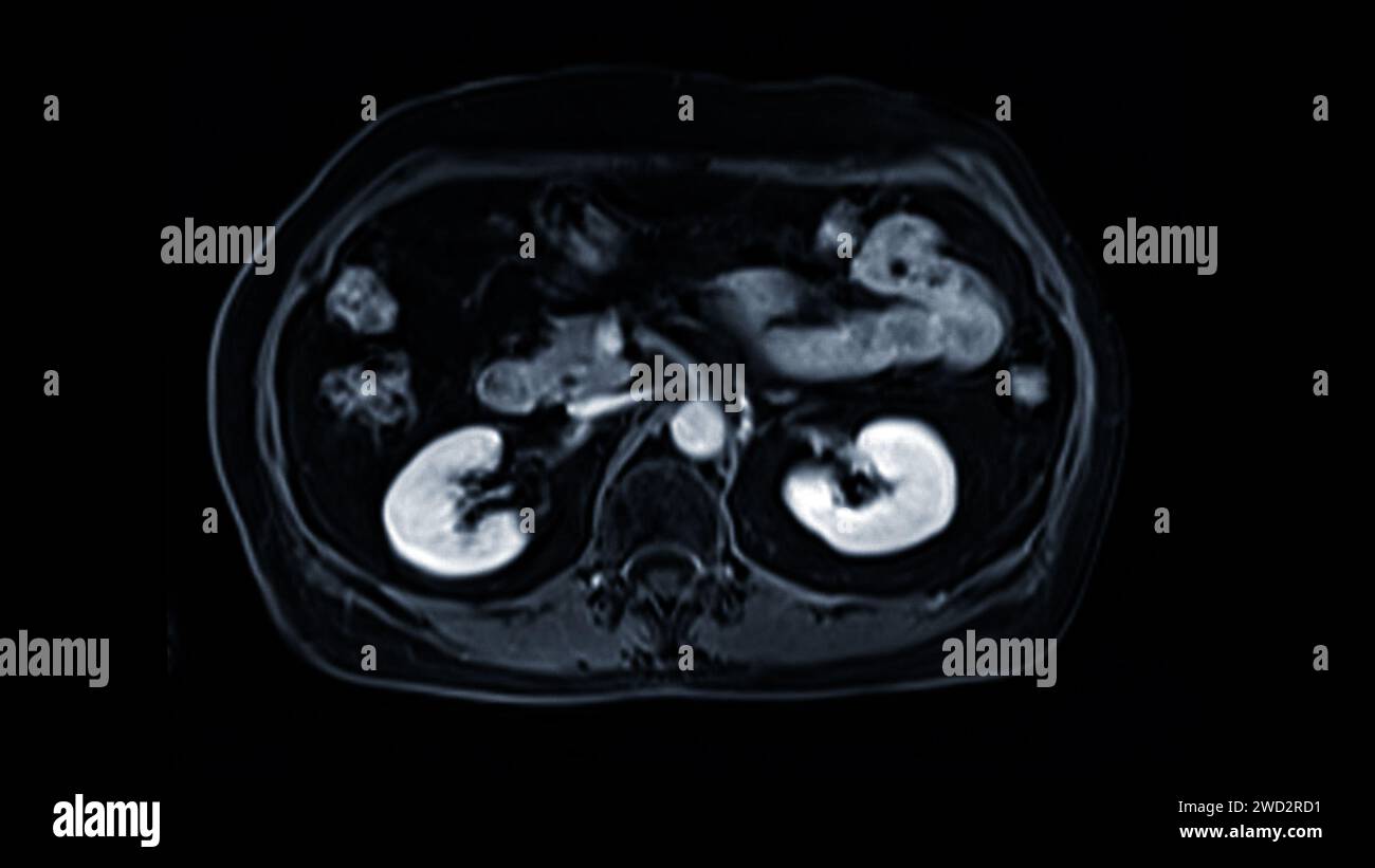 L'IRM de la vue axiale de la partie supérieure de l'abdomen est une technique d'imagerie non invasive qui fournit des images détaillées d'organes comme le foie, le pancréas et les reins. Banque D'Images