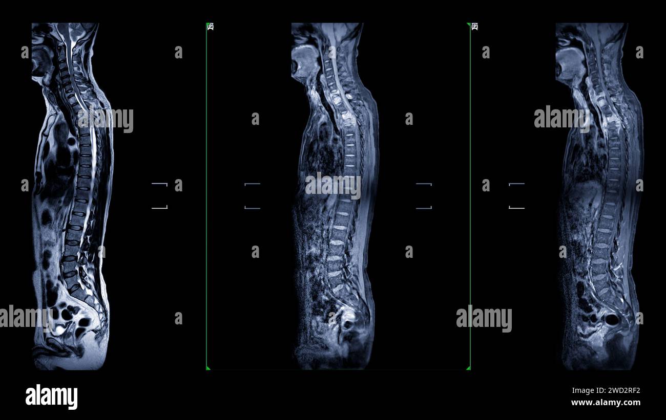 Une IRM de l'ensemble du rachis est une représentation visuelle complète produite par imagerie par résonance magnétique, fournissant des informations détaillées sur Banque D'Images