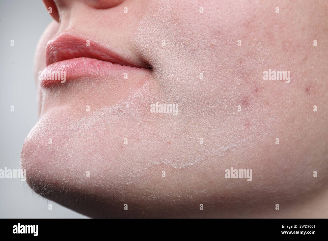 Femme avec la peau sèche sur le visage sur fond clair, gros plan Banque D'Images