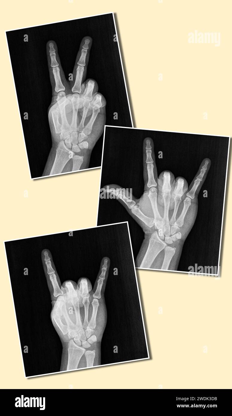 Film radiographie ou radiographie d'une main et des doigts montrant le signe groovy de paix hippie des années 1960 ou V, je t'aime, rock sur corne du diable. aka paix, amour Banque D'Images