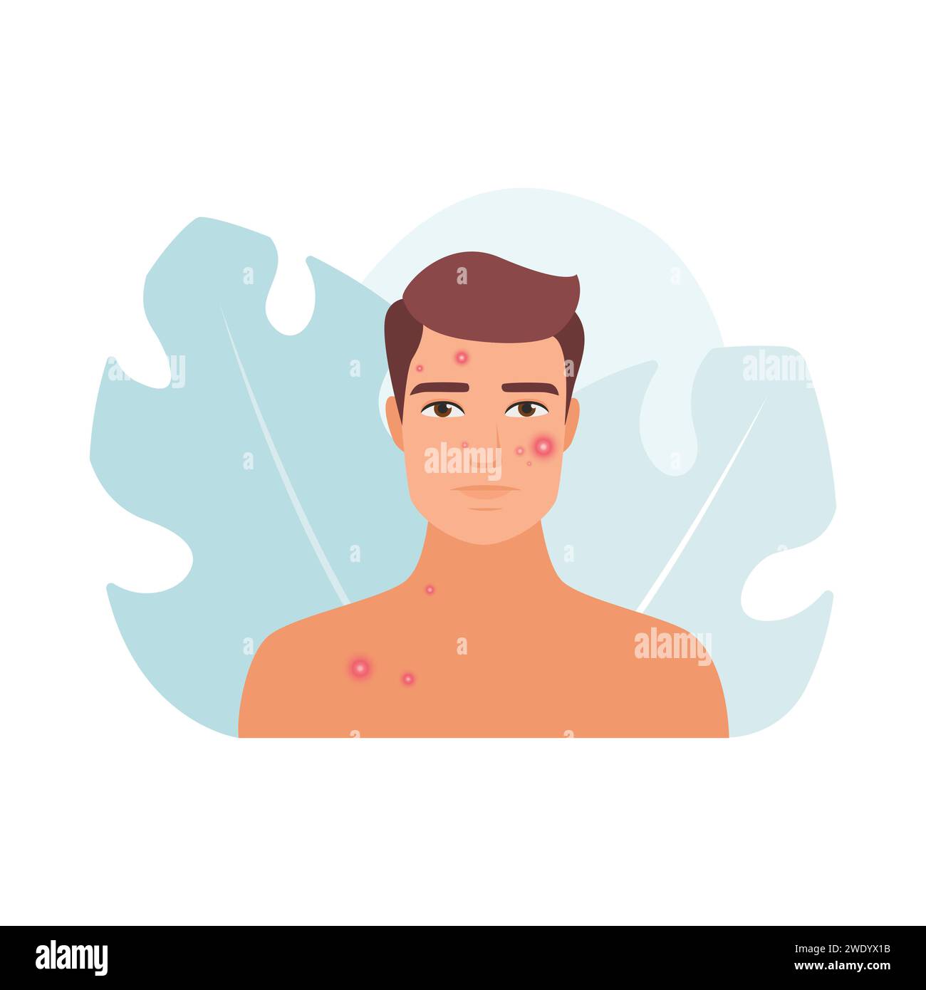 Homme inquiet triste avec problème d'acné et boutons rouges sur illustration vectorielle de visage Illustration de Vecteur