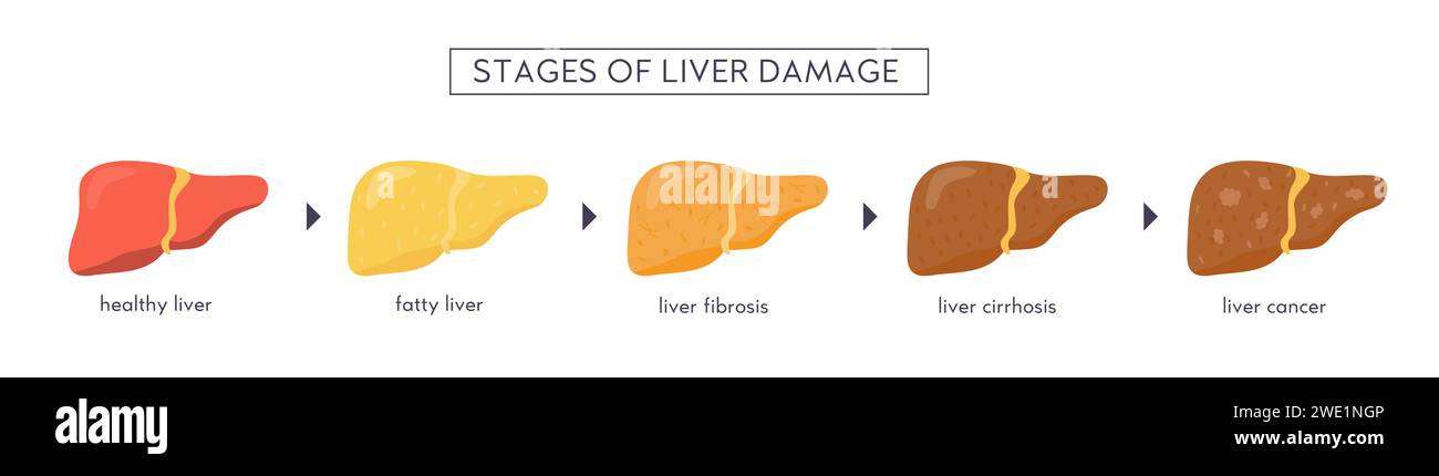 Les stades de l'atteinte hépatique non alcoolique. Sain, gras, stéatose, NASH, fibrose, cirrhose, cancer. Infographie médicale des maladies du foie. Bannière vectorielle Illustration de Vecteur