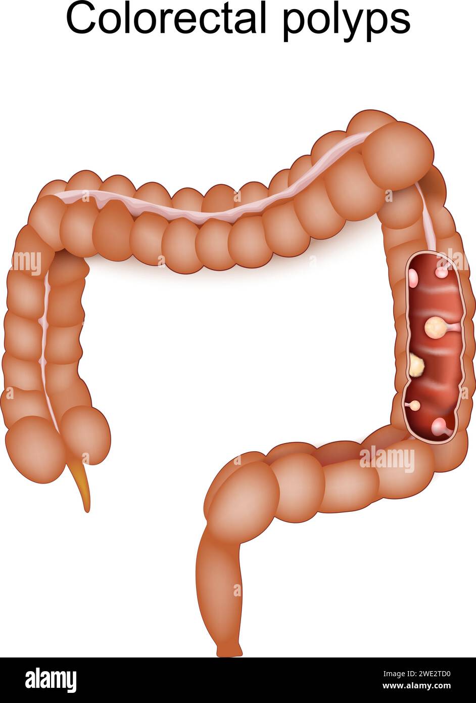Polypes colorectaux et cancer du côlon. Le gros intestin humain avec conséquence d'une maladie inflammatoire intestinale. Illustration vectorielle Illustration de Vecteur