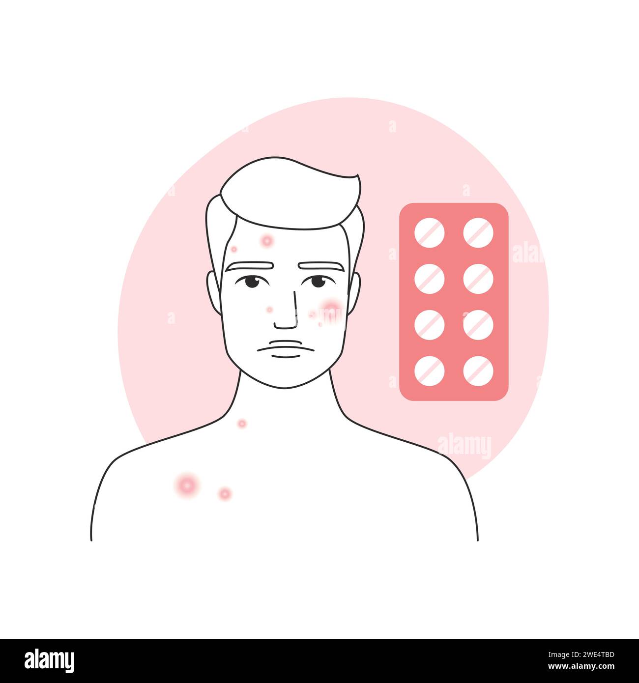 Traitement médical de l'acné pubertaire pour homme triste avec boutons sur l'illustration vectorielle du visage Illustration de Vecteur