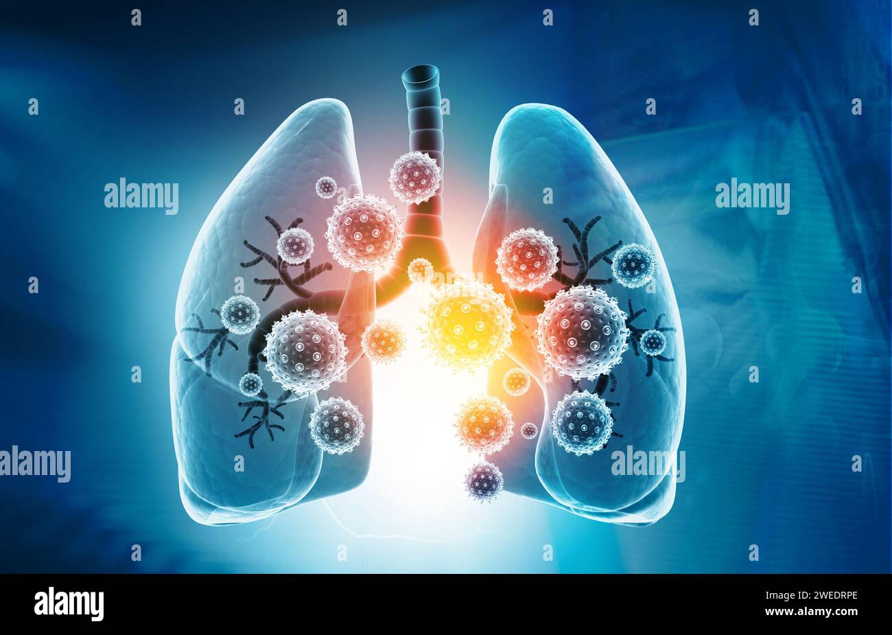Infections pulmonaires virales, infection pulmonaire conepte. illustration 3d. Banque D'Images