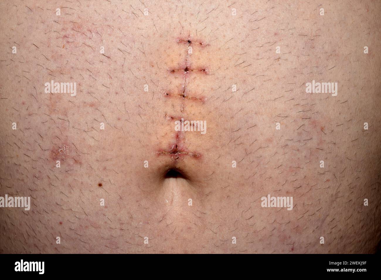 Vue d'une suture curative sur l'abdomen bombé d'un homme. Banque D'Images
