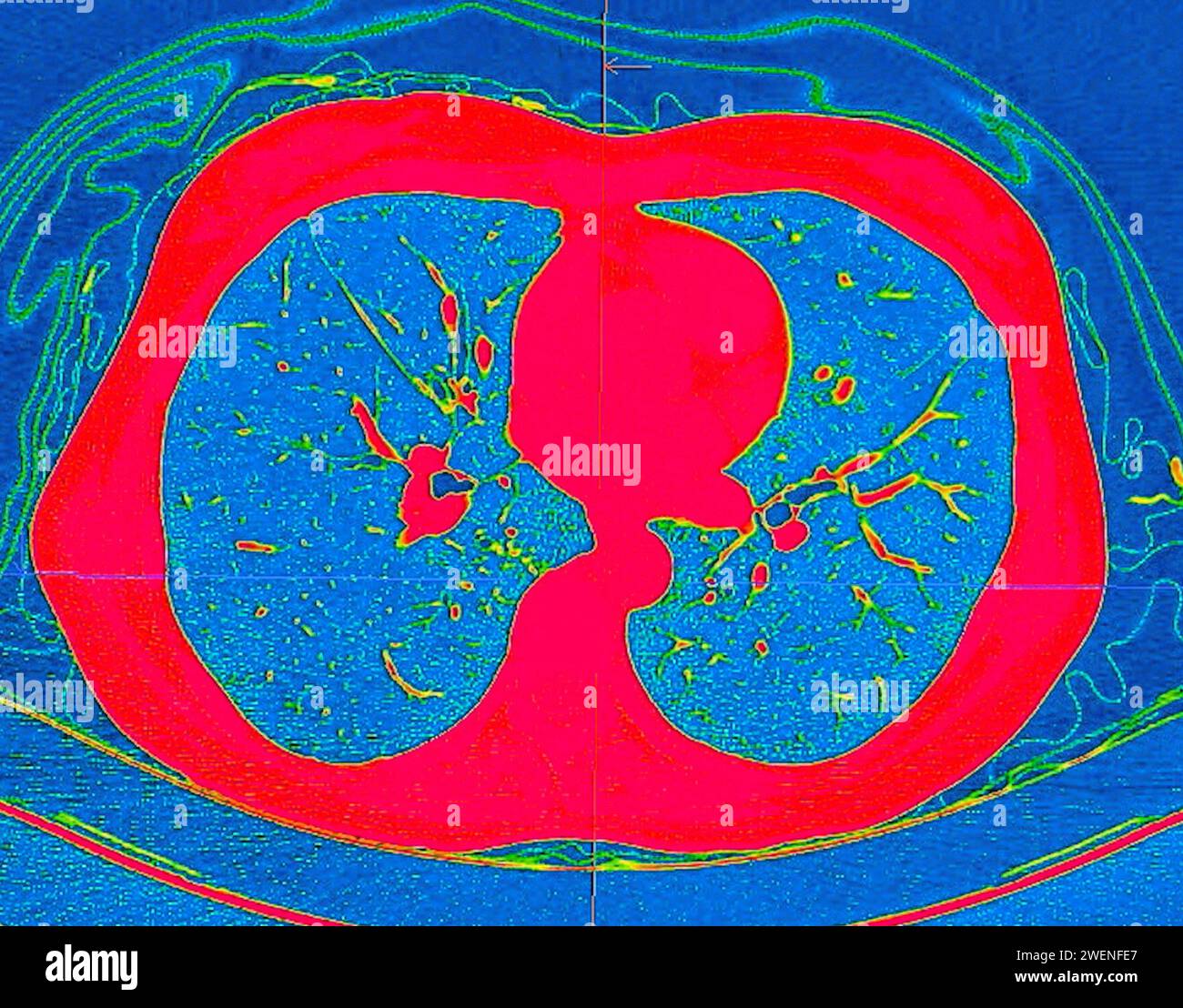 Tomodensitométrie de la vue axiale thorax en mode couleur pour le diagnostic d'embolie pulmonaire (EP) , de cancer du poumon et de covid-19. Banque D'Images