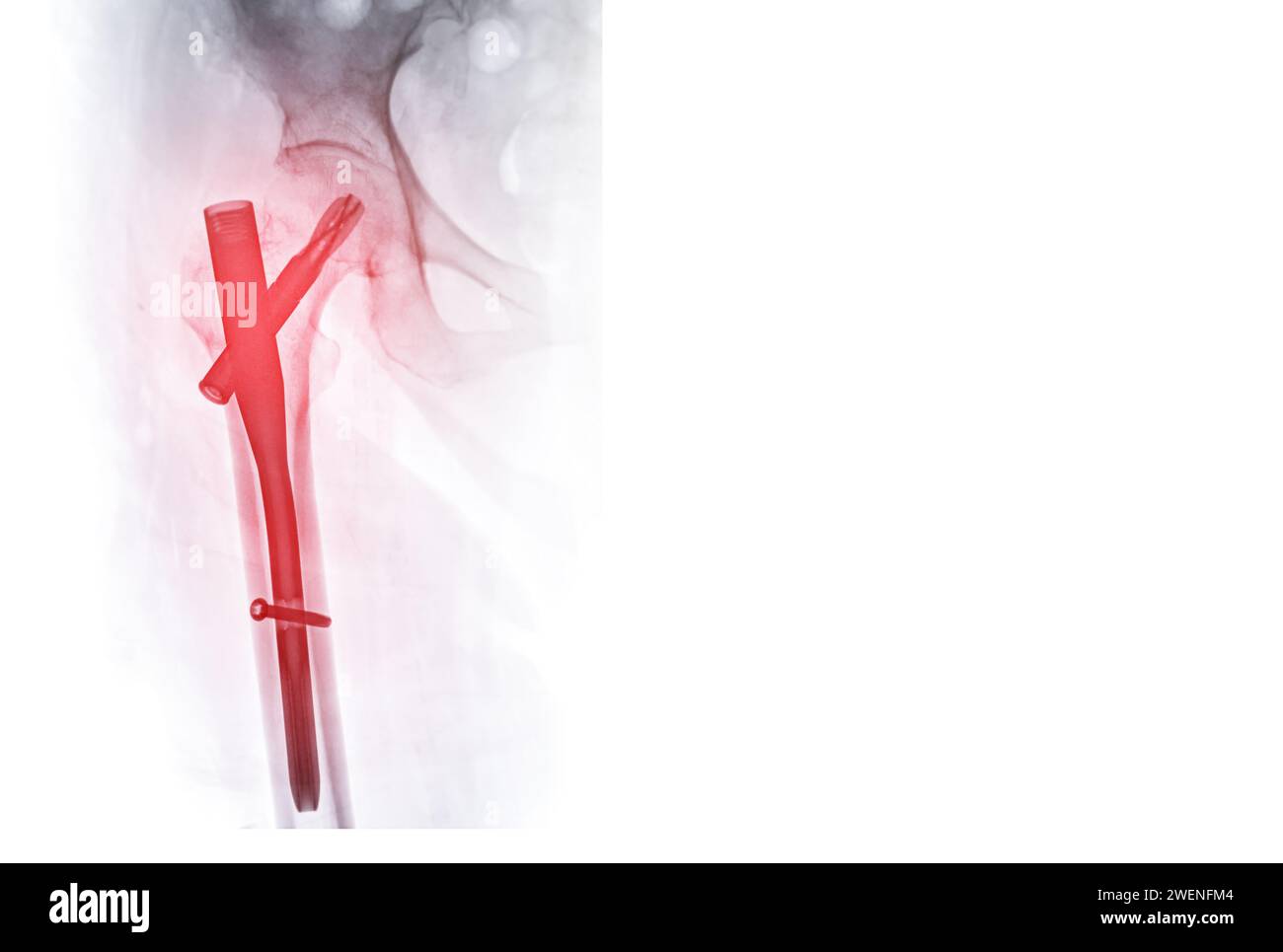 Une radiographie révèle les deux articulations de la hanche avec hémiarthroplastie, mettant en évidence le succès de la procédure chirurgicale et fournissant un témoignage visuel du resto Banque D'Images