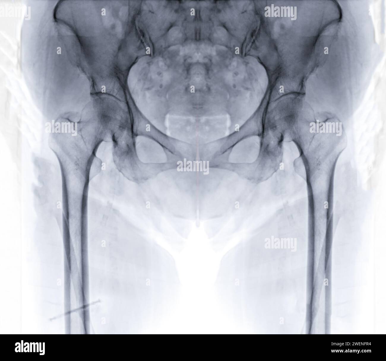 Une radiographie révèle les deux articulations de la hanche dans une étude normale. Banque D'Images