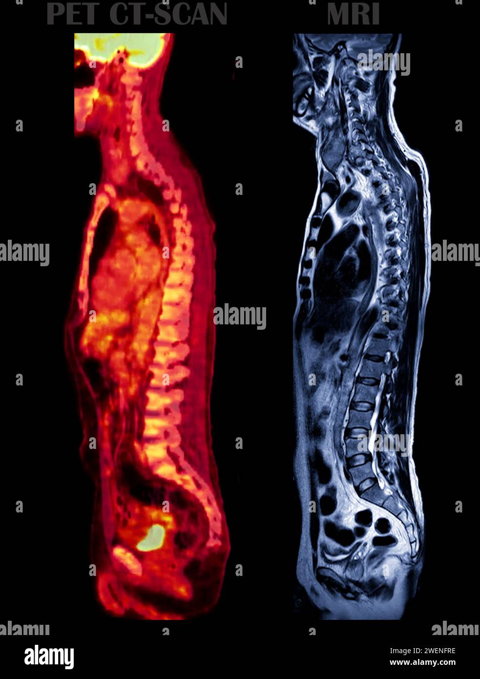 Une image TEP-TDM et une vue sagittale du rachis entier de screening IRM. Banque D'Images