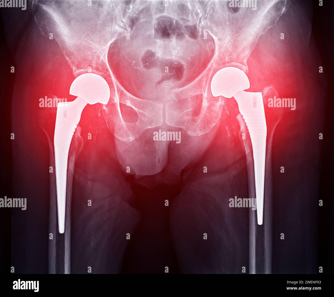 Une radiographie révèle les deux articulations de la hanche avec ARTHROPLASTIE TOTALE DE LA HANCHE, mettant en évidence le succès de la procédure chirurgicale et fournissant un témoignage visuel de la Banque D'Images