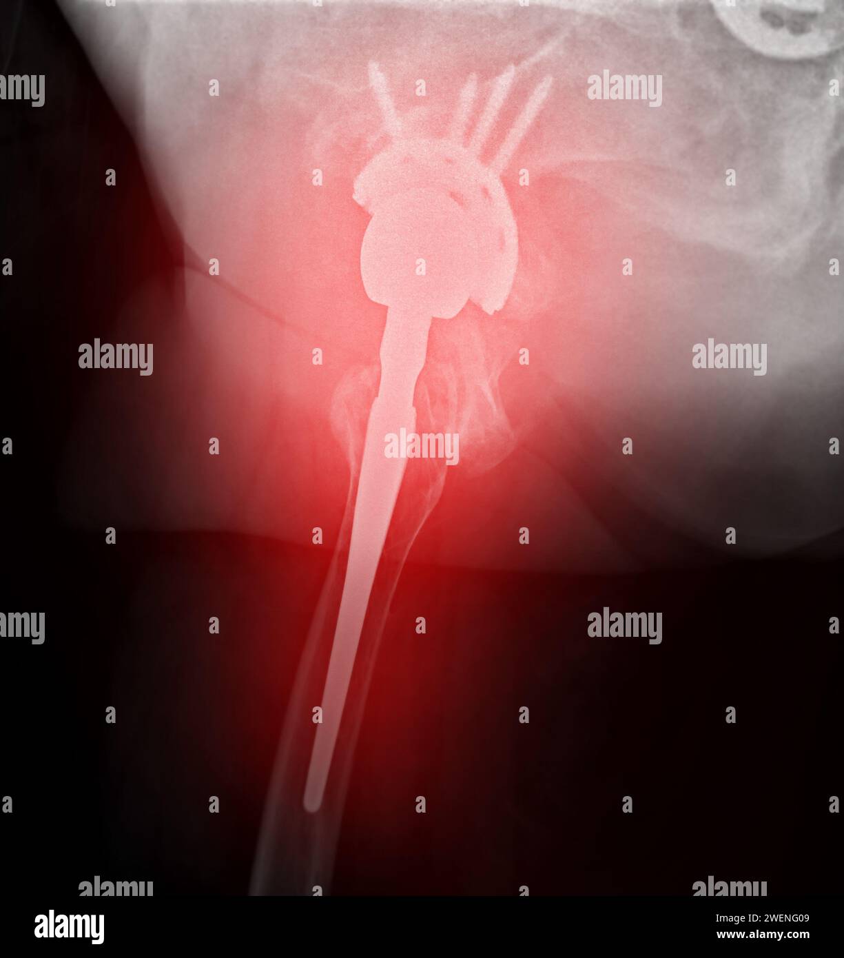 Une radiographie révèle les deux articulations de la hanche avec ARTHROPLASTIE TOTALE DE LA HANCHE, mettant en évidence le succès de la procédure chirurgicale et fournissant un témoignage visuel de la Banque D'Images