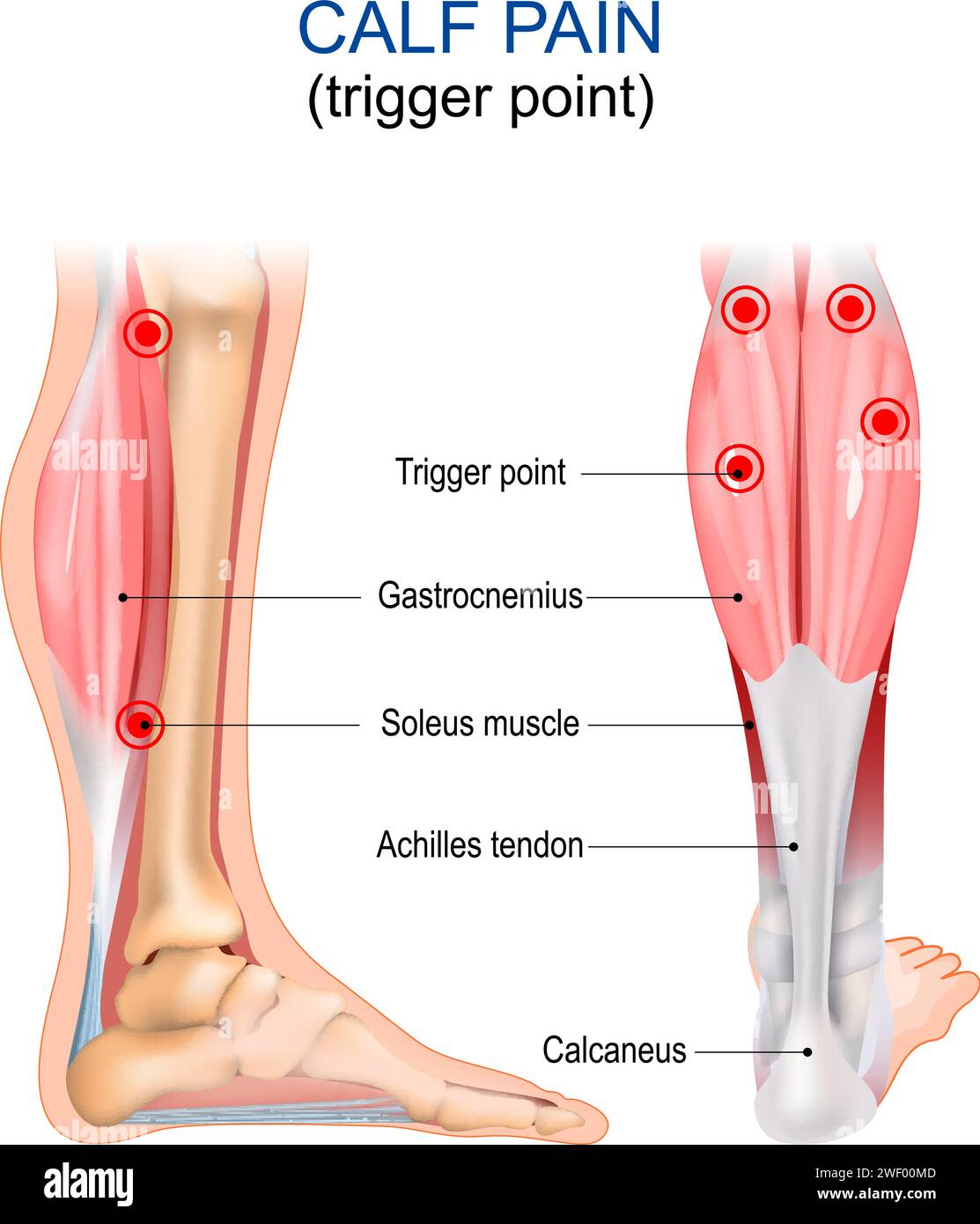 Douleur du mollet. Point de déclenchement. Gastrocnémien, muscle soléaire, tendon d'Achille et calcanéum. Syndrome douloureux myofascial. Anatomie du corps humain. Illustration vectorielle Illustration de Vecteur Douleur du mollet. Point de déclenchement. Gastrocnémien, muscle soléaire, tendon d'Achille et calcanéum. Syndrome douloureux myofascial. Anatomie du corps humain. Illustration vectorielle Illustration de Vecteur