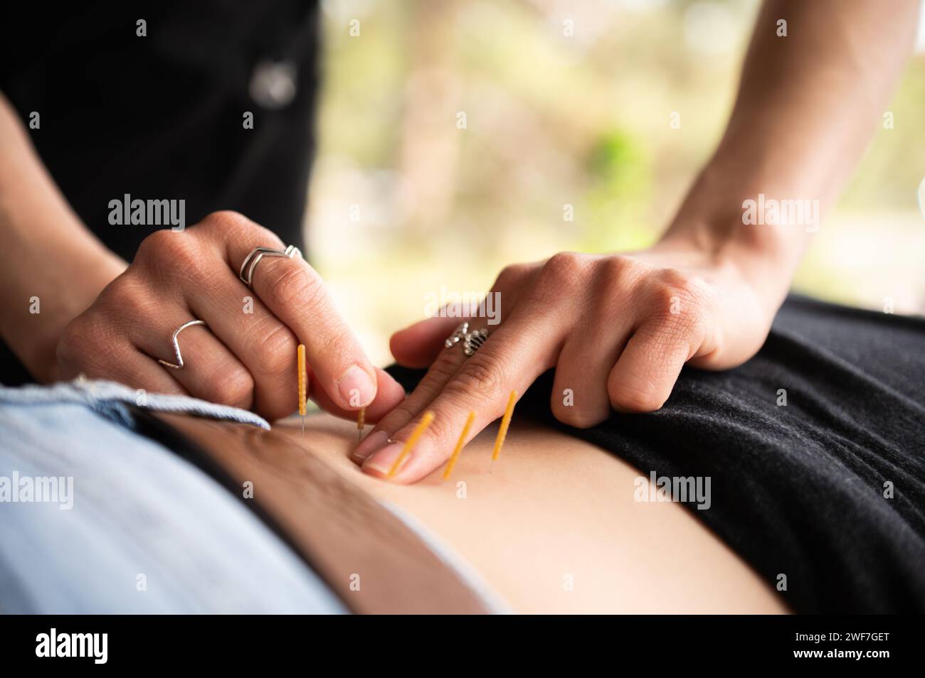 Insertion de l'aiguille : soins holistiques, soulagement du bas du dos. Banque D'Images