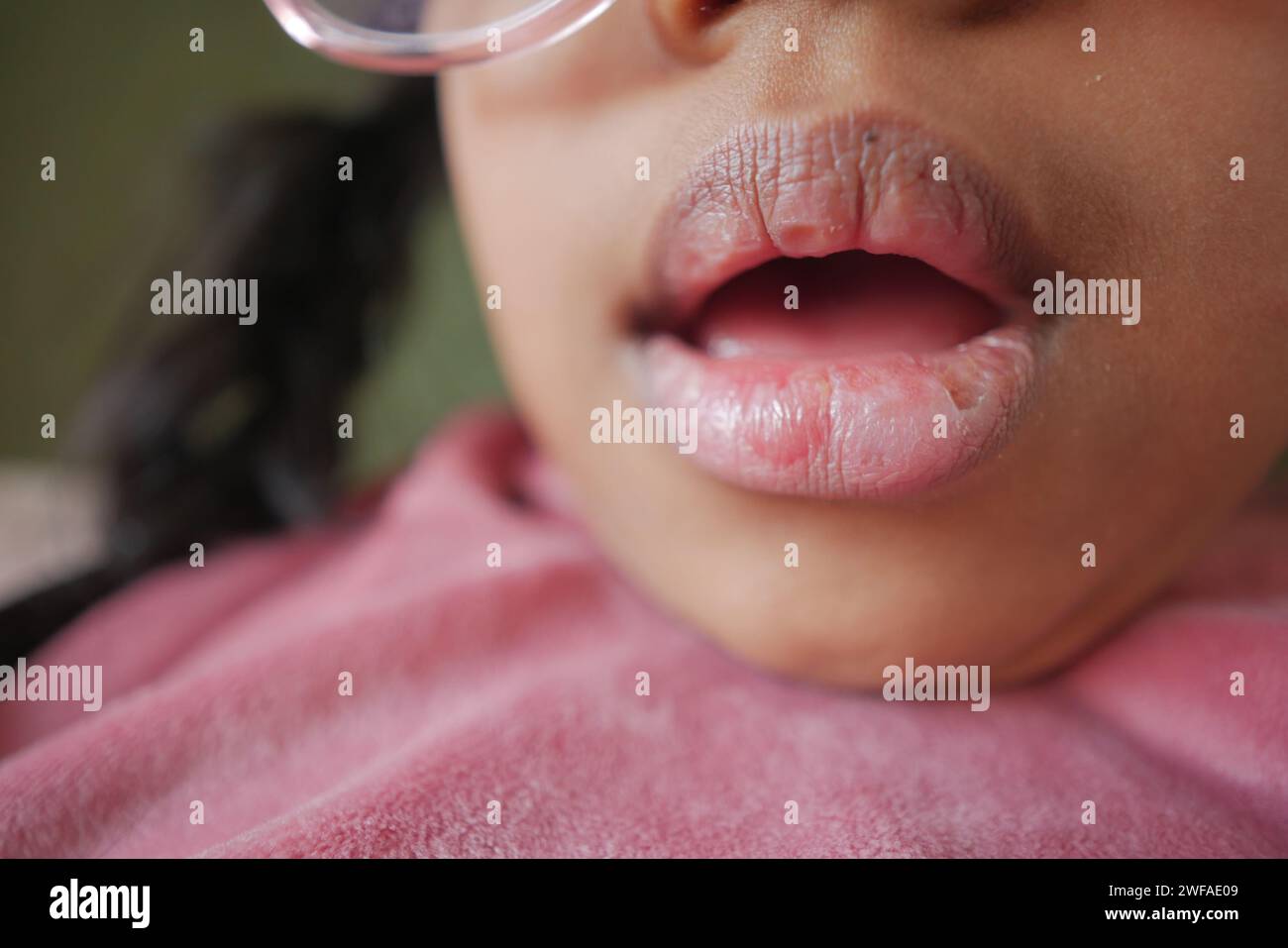 gros plan de la lèvre sèche d'un enfant Banque D'Images