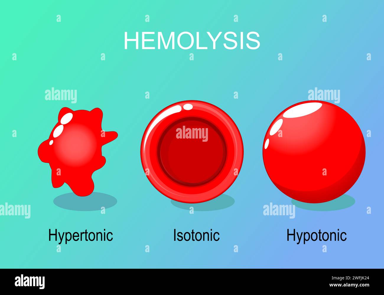 Hémolyse des globules rouges. Érythrocytes hypertoniques, hypotoniques et isotoniques. Illustration vectorielle Illustration de Vecteur