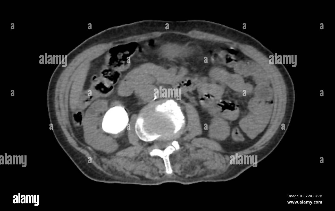 Calculs rénaux, TDM Banque D'Images