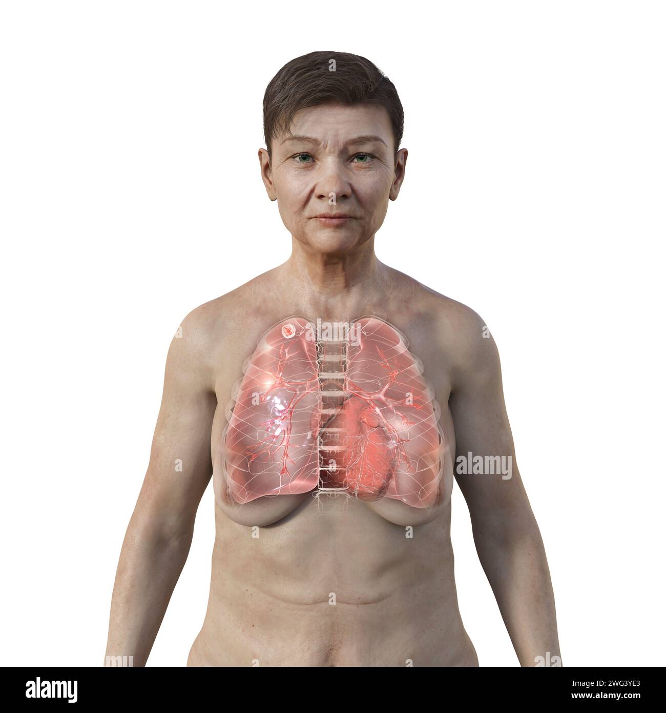 Femme atteinte de tuberculose apicale, illustration Banque D'Images