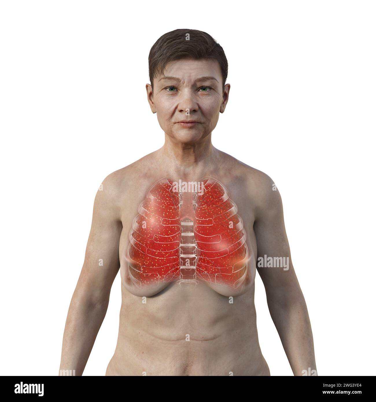 Femme atteinte de miliaire pulmonaire tuberculeuse, illustration Banque D'Images
