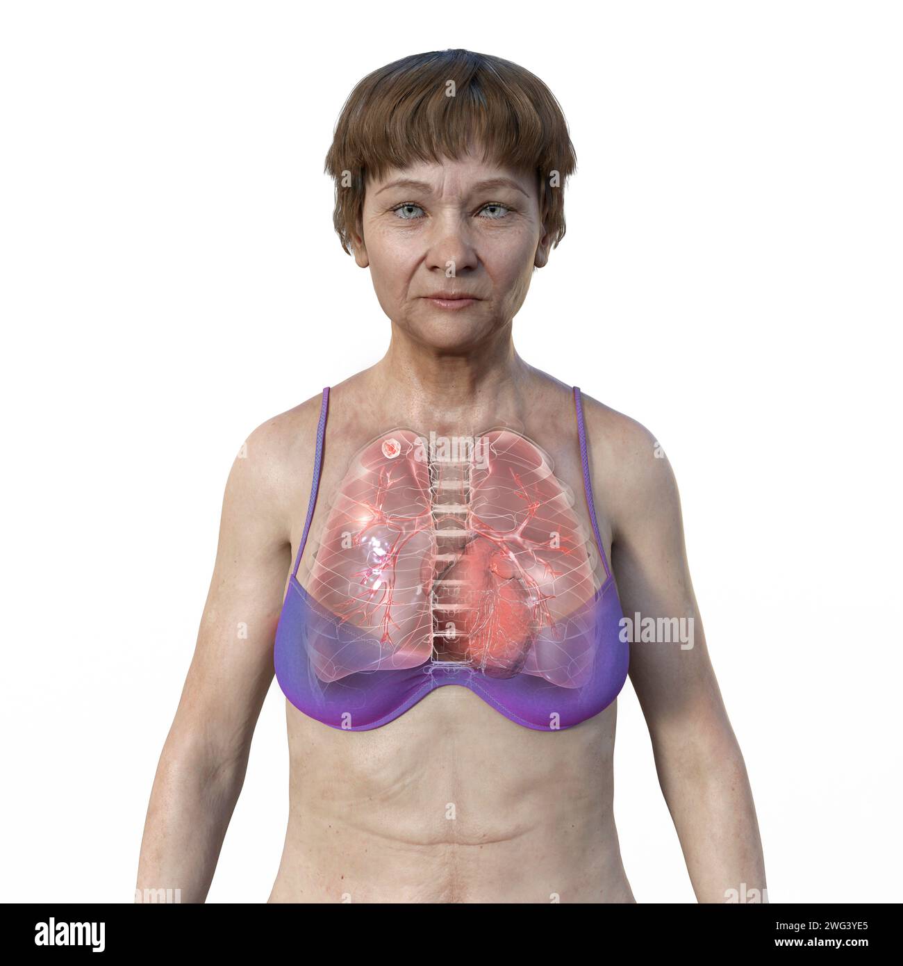 Femme atteinte de tuberculose apicale, illustration Banque D'Images