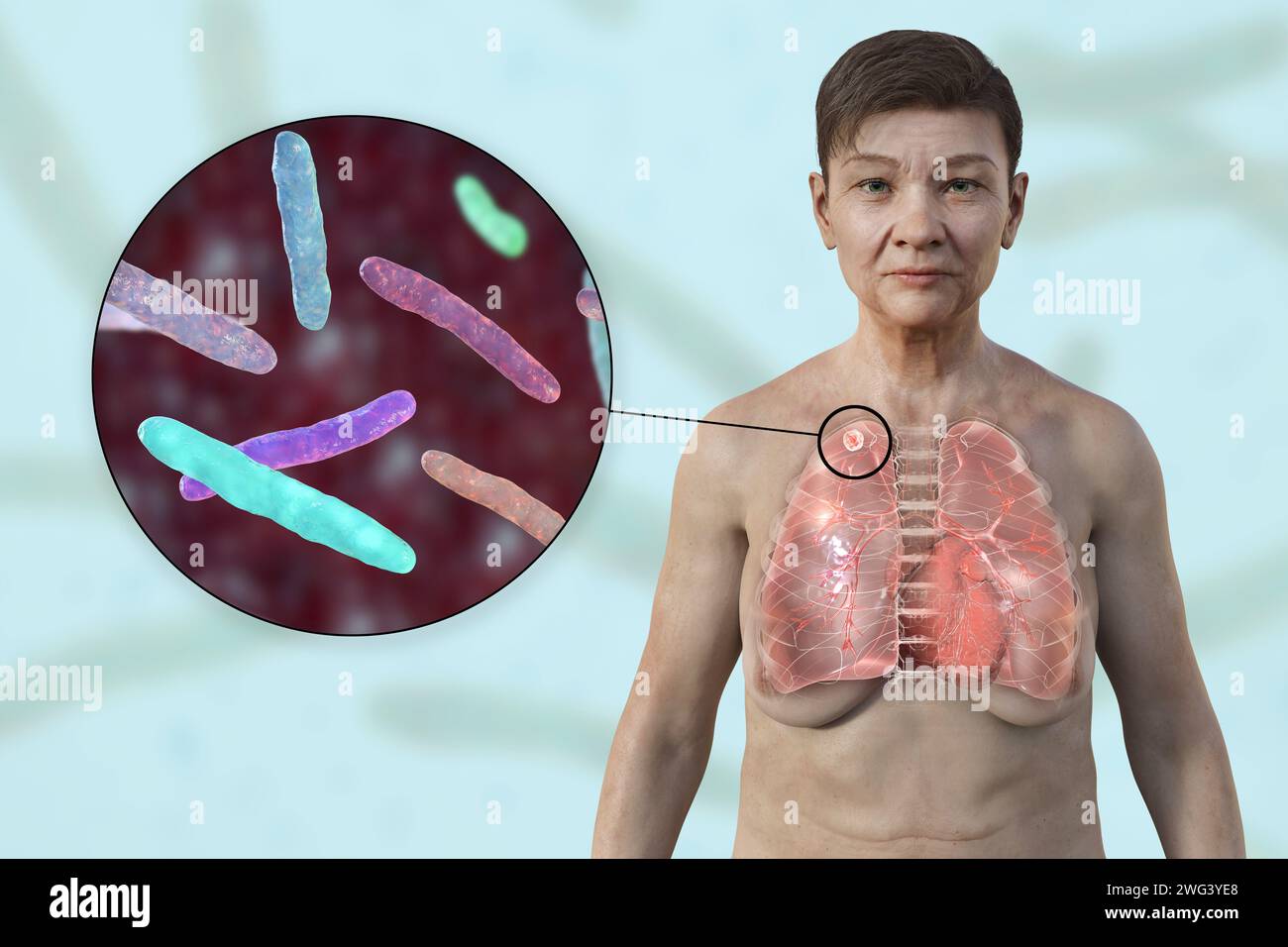 Femme atteinte de tuberculose apicale, illustration Banque D'Images
