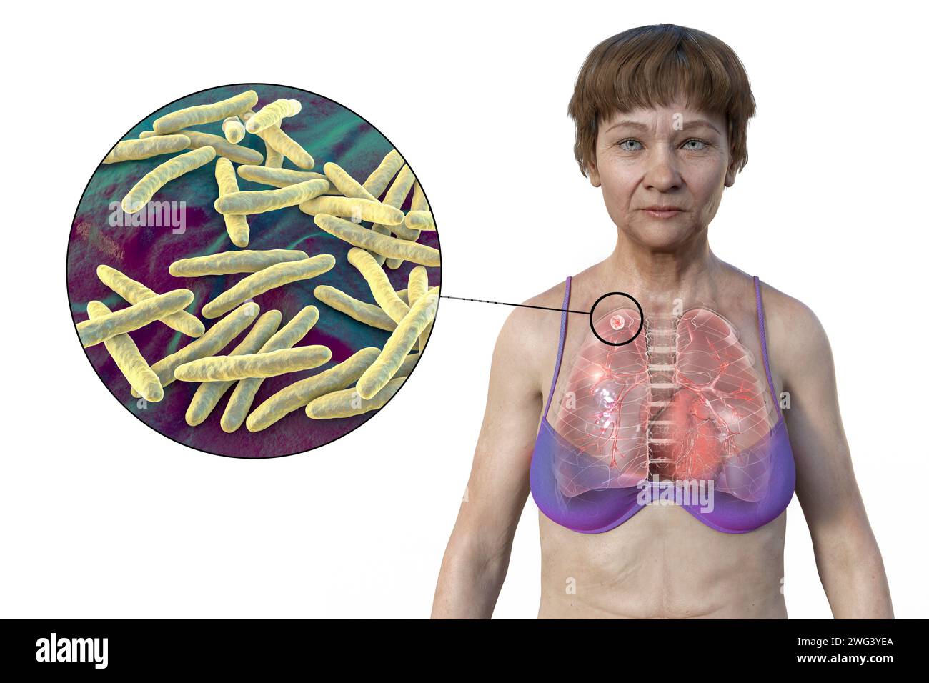 Femme atteinte de tuberculose apicale, illustration Banque D'Images