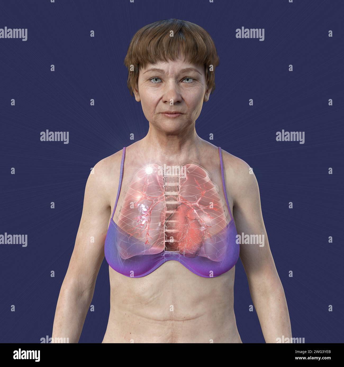 Femme atteinte de tuberculose apicale, illustration Banque D'Images