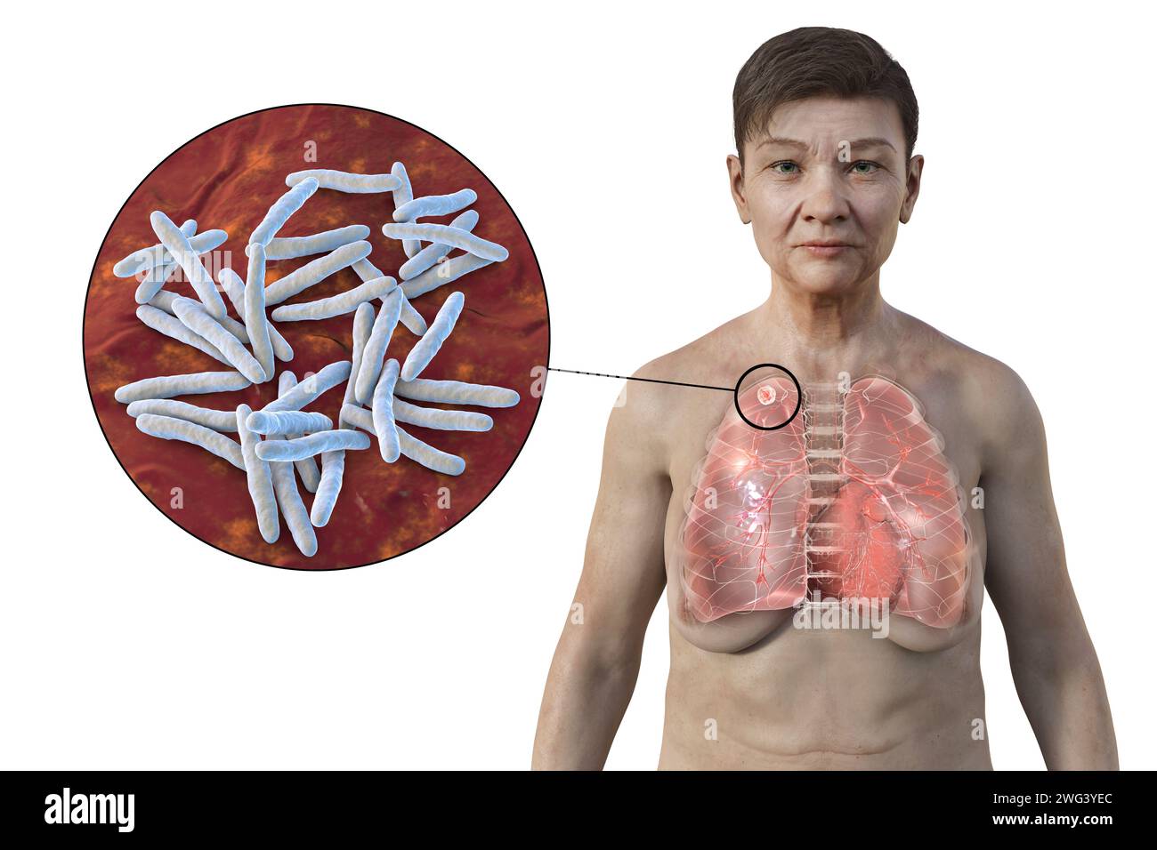 Femme atteinte de tuberculose apicale, illustration Banque D'Images
