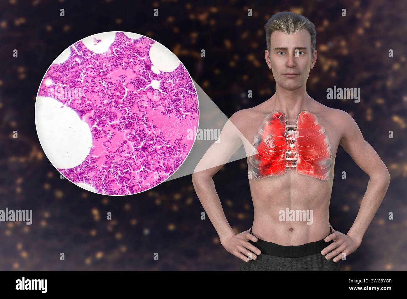 Homme avec des poumons affectés par une pneumonie, illustration Banque D'Images