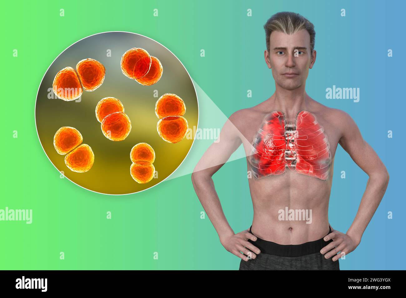 Homme avec des poumons affectés par une pneumonie, illustration Banque D'Images