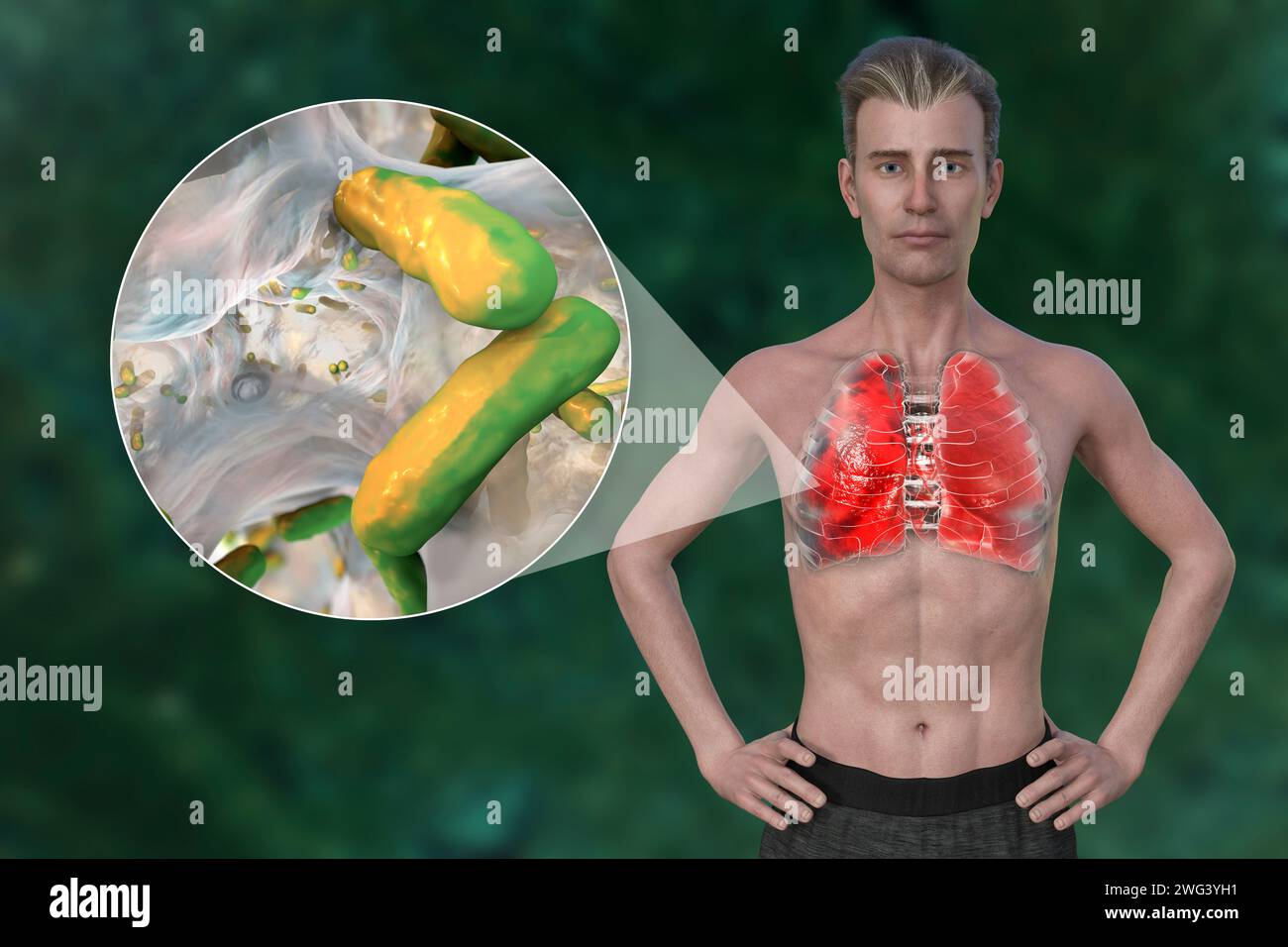 Homme avec des poumons affectés par une pneumonie, illustration Banque D'Images