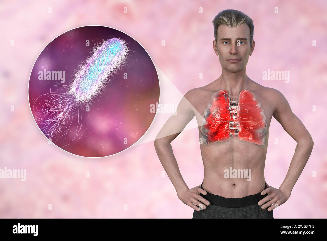 Homme avec des poumons affectés par une pneumonie, illustration Banque D'Images