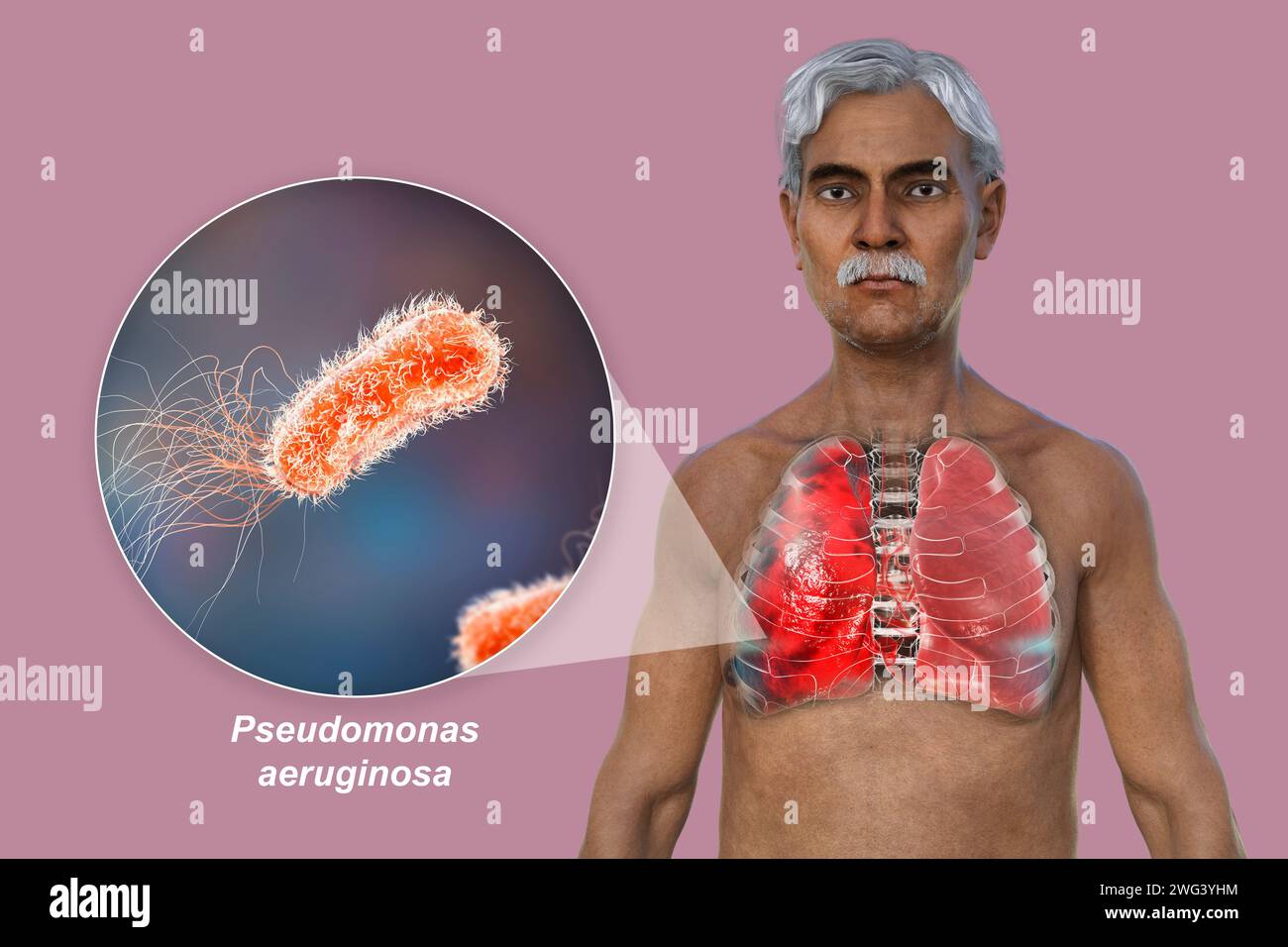 Homme avec des poumons affectés par une pneumonie, illustration Banque D'Images