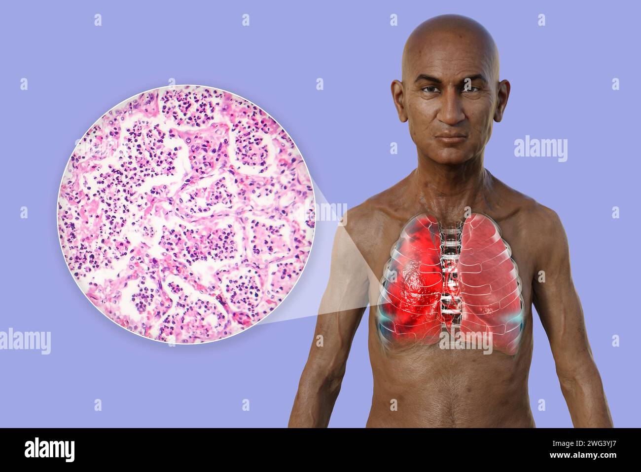 Homme avec des poumons affectés par une pneumonie, illustration Banque D'Images