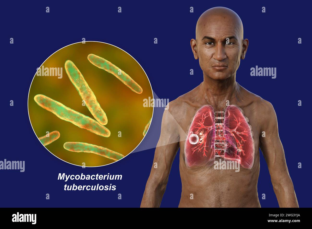 Homme aux poumons atteints de tuberculose caverneuse, illustration Banque D'Images
