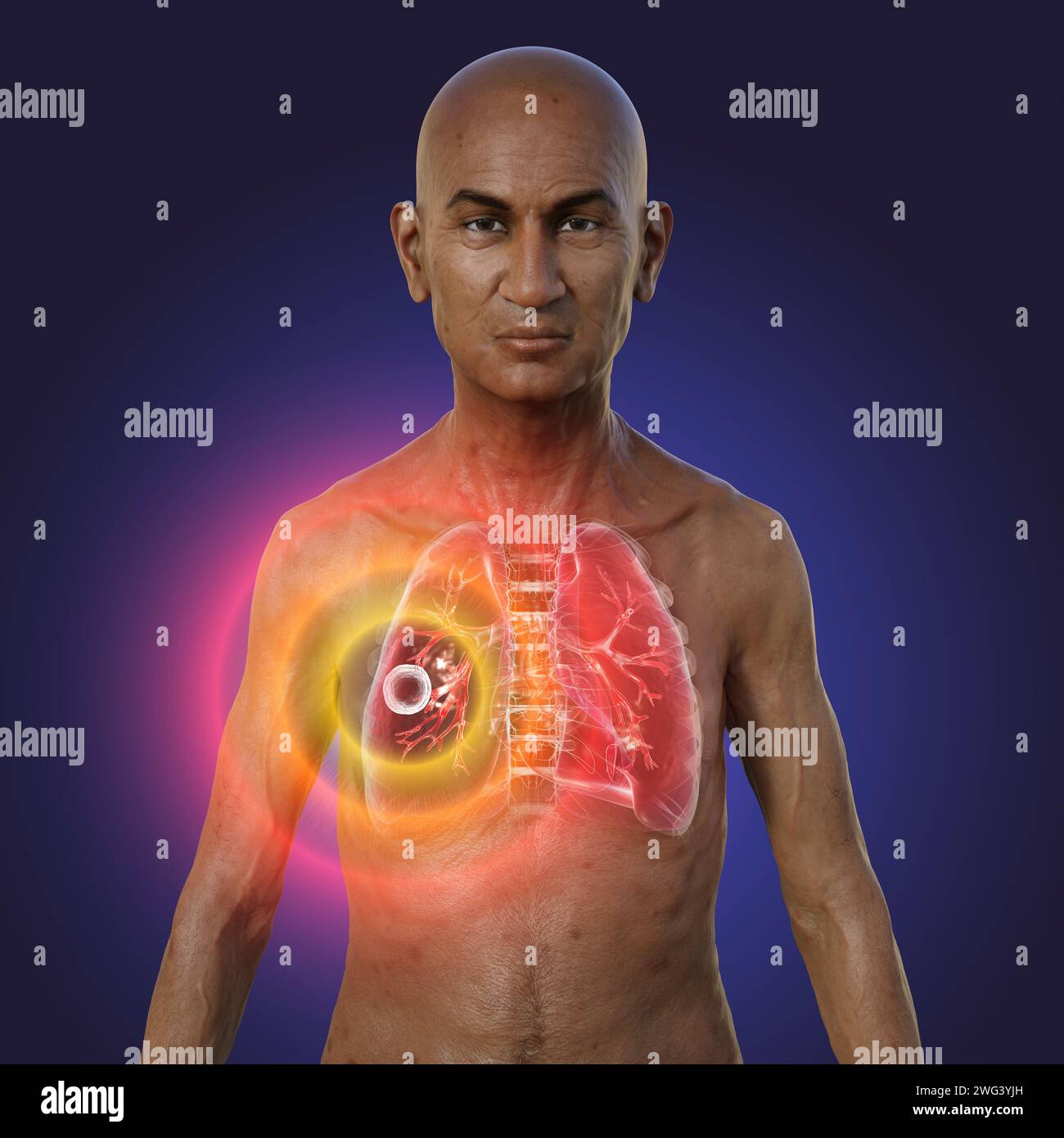 Homme aux poumons atteints de tuberculose caverneuse, illustration Banque D'Images