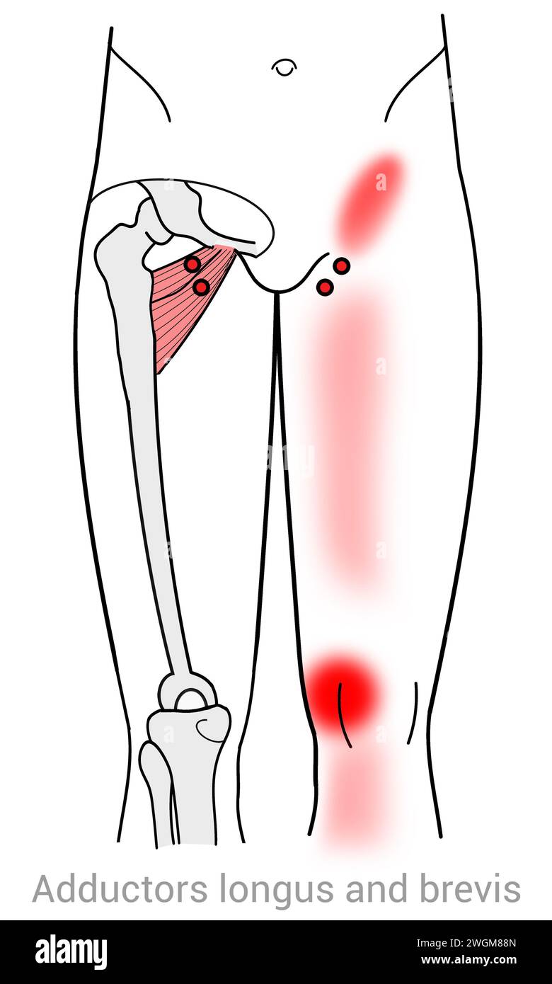 Adductors Longus & Brevis : points de déclenchement myofasciaux et localisations douloureuses associées Banque D'Images